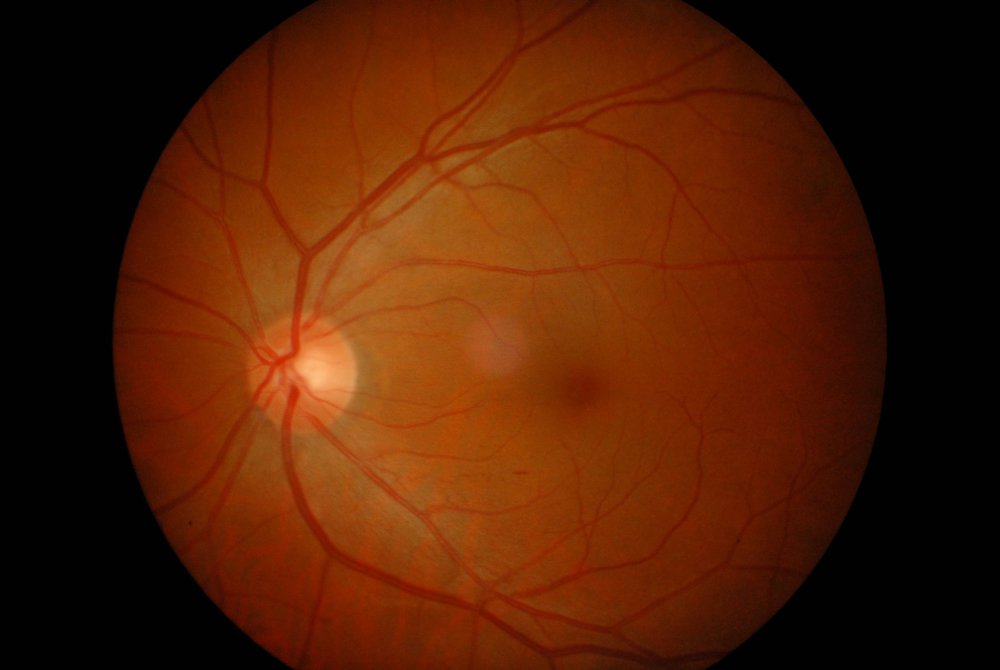 11pucker maculare oftalmologia